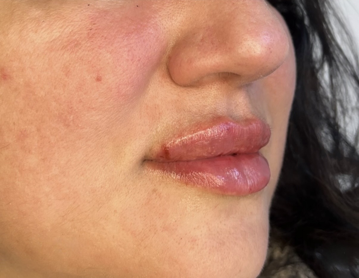 Før og efter resultat af læbefiller behandling nummer to